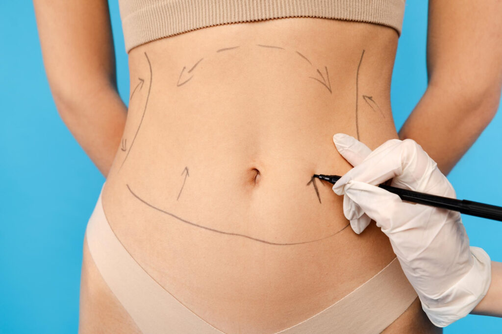 diferencias abdominoplastia y liposucción