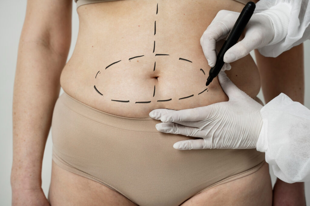 liposucción o abdominoplastia