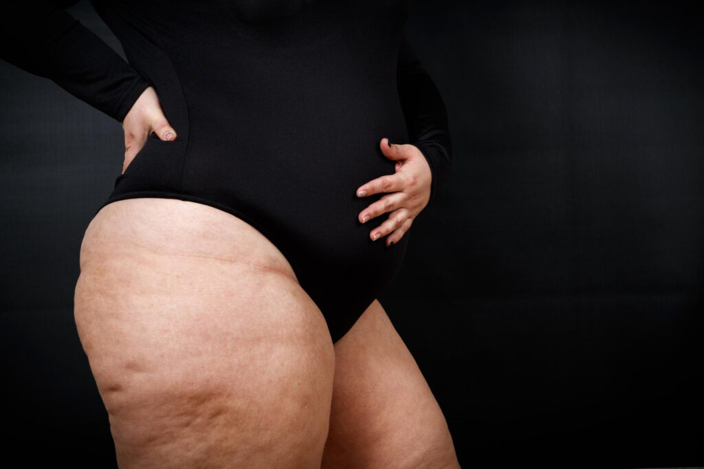 mujer con lipedema en piernas