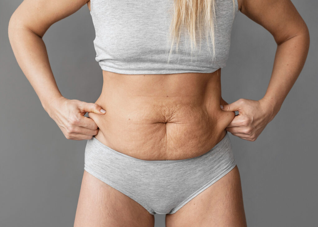 chica con diástasis abdominal leve