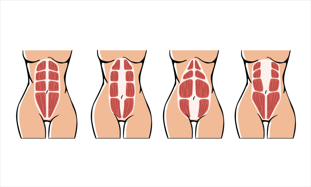 ejemplos de diástasis abdominal