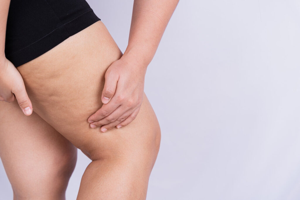 chica con lipedema o celulitis