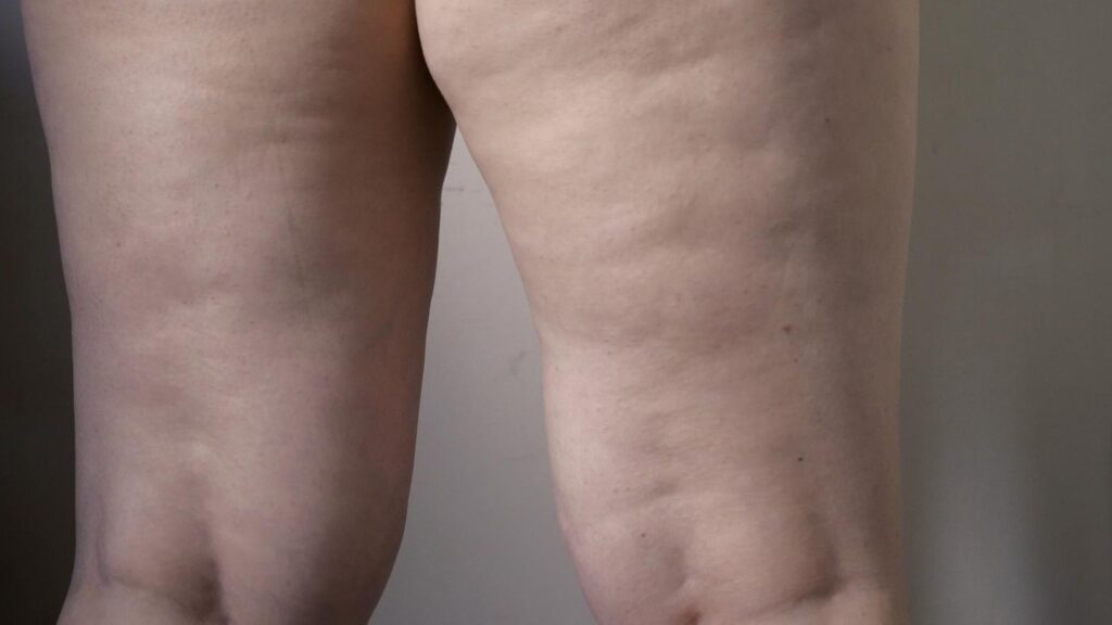 saber si tienes lipedema