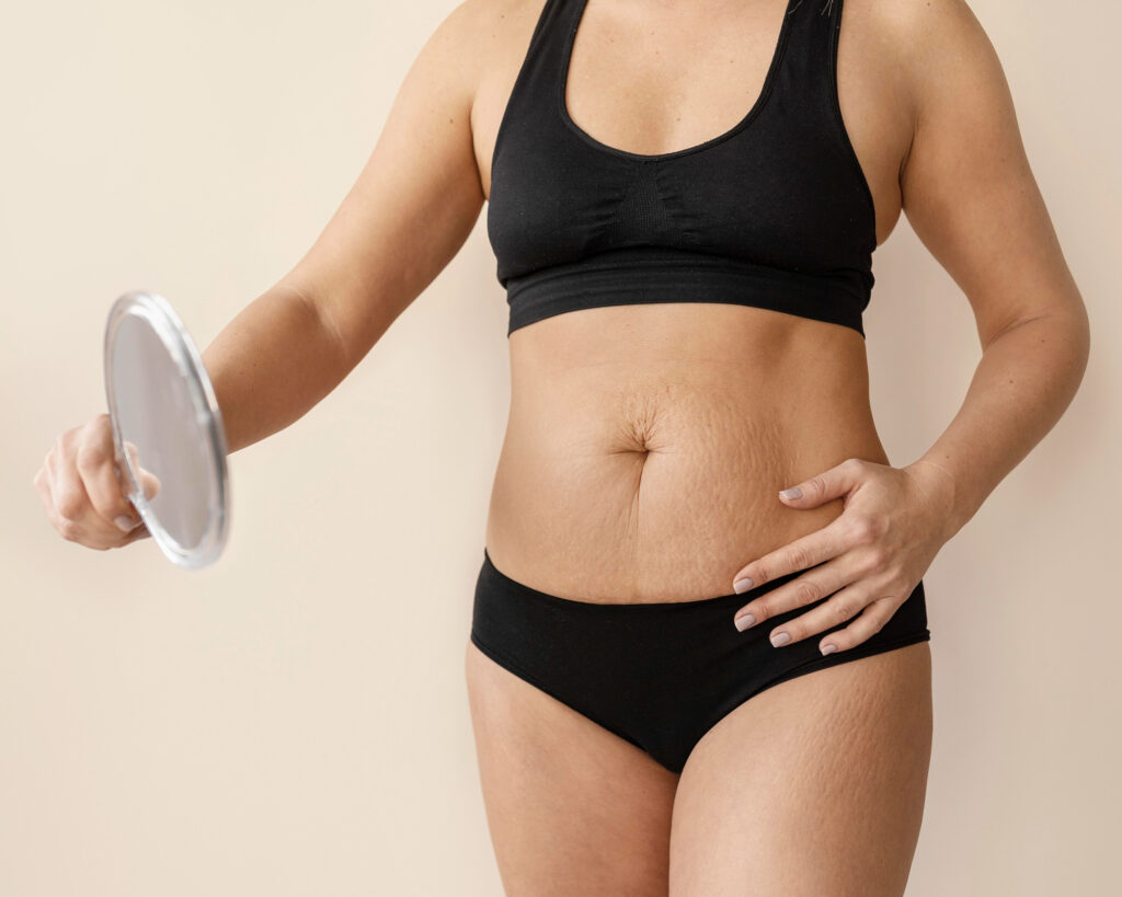 mujer con diastasis abdominal