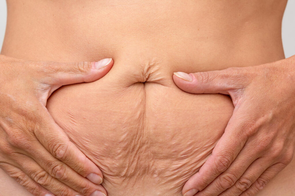 causa de diastasis abdominal en el embarazo