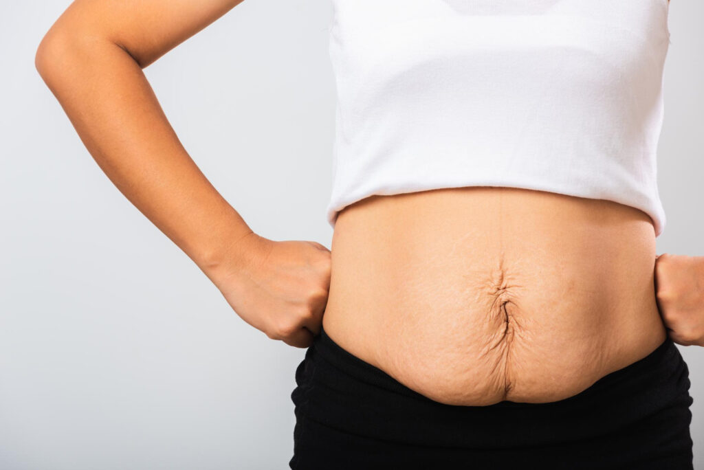 diastasis abdominal tras embarazo