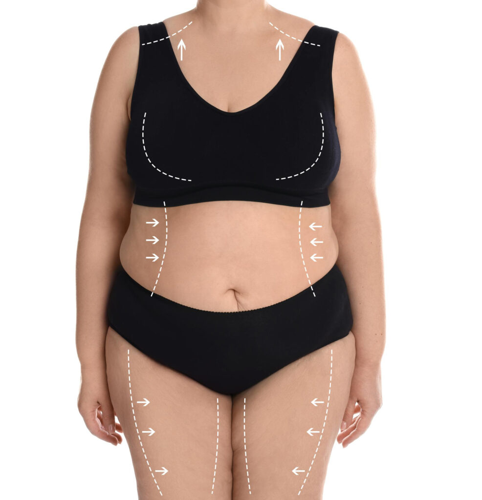 liposuccion varias zonas