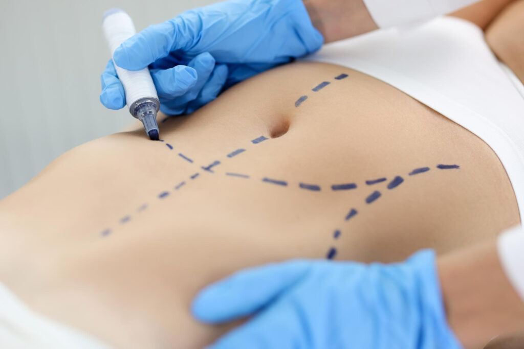 tratar diastasis abdominal con cirugia