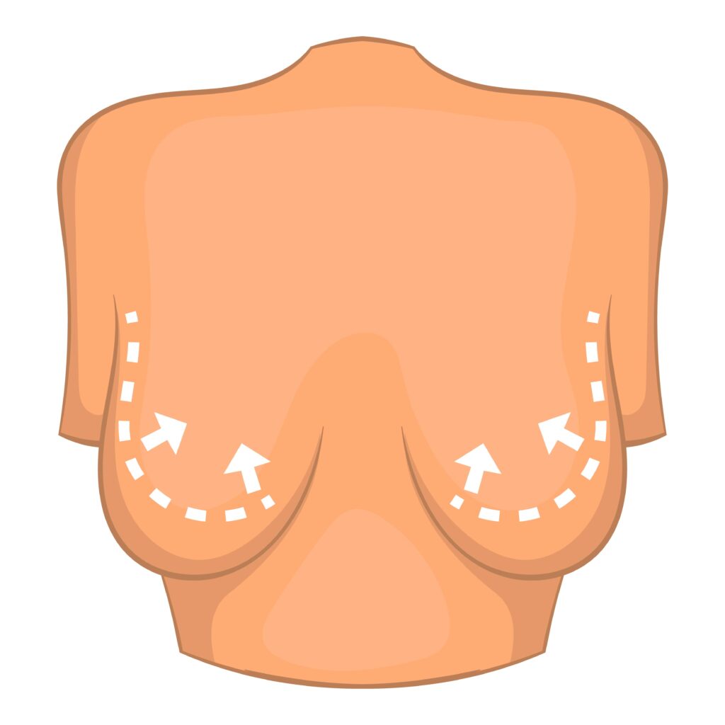 Ilustración mastopexia explicación