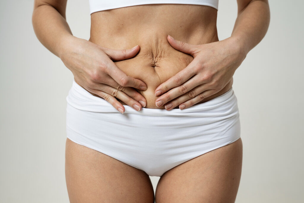 mujer que necesita hacerse una abdominoplastia