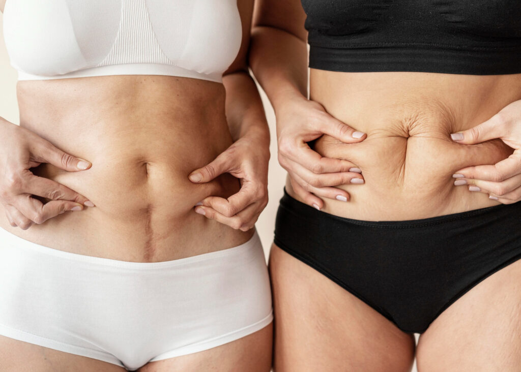tener barriga despues de abdominoplastia