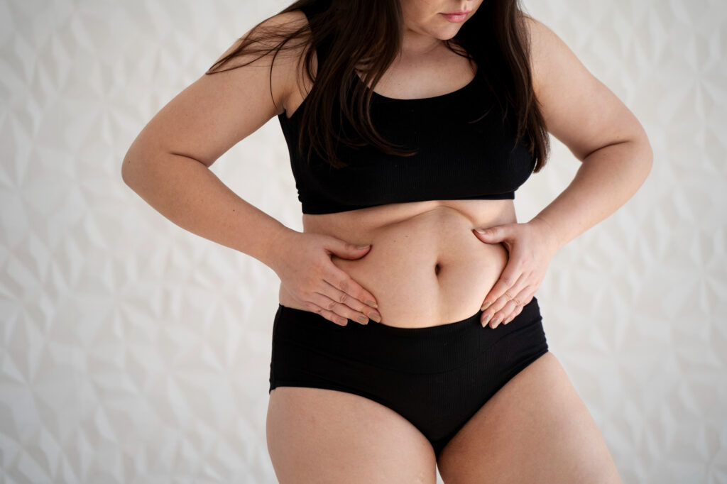 barriga hinchada después de abdominoplastia