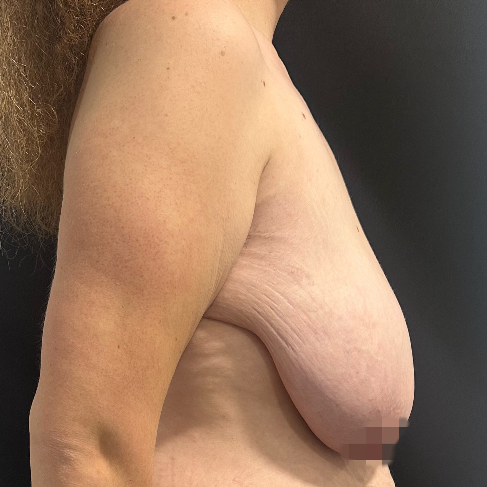 Antes del tratamiento, vista de perfil