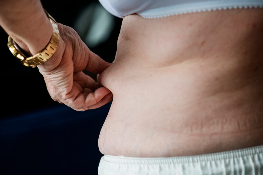 Cuándo debes llamar a un médico si sufres tras la liposucción
