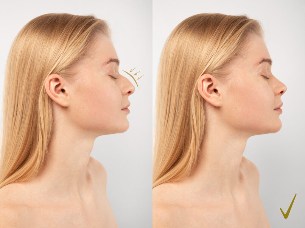 Cuándo elegir rinoplastia o rinomodelación